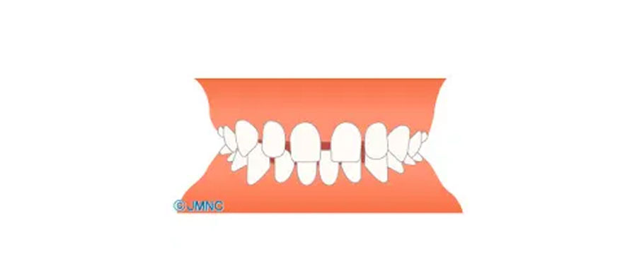 空隙歯列
